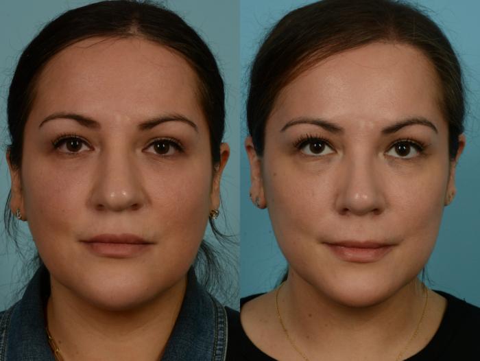 Before & After Rhinoplasty by Dr. Mustoe Case 1107 Front View in Chicago, IL