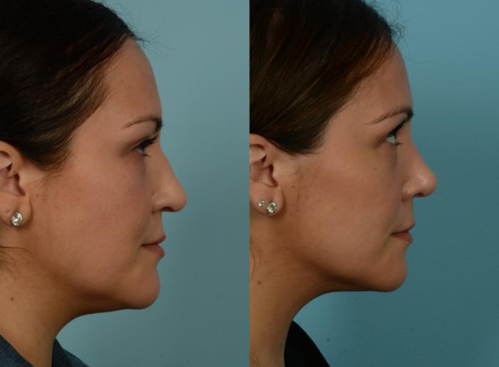 Before & After Rhinoplasty by Dr. Mustoe Case 1107 Left Side View in Chicago, IL