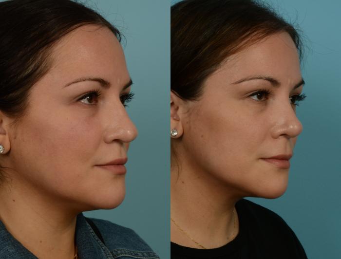 Before & After Rhinoplasty by Dr. Mustoe Case 1107 Right Oblique View in Chicago, IL