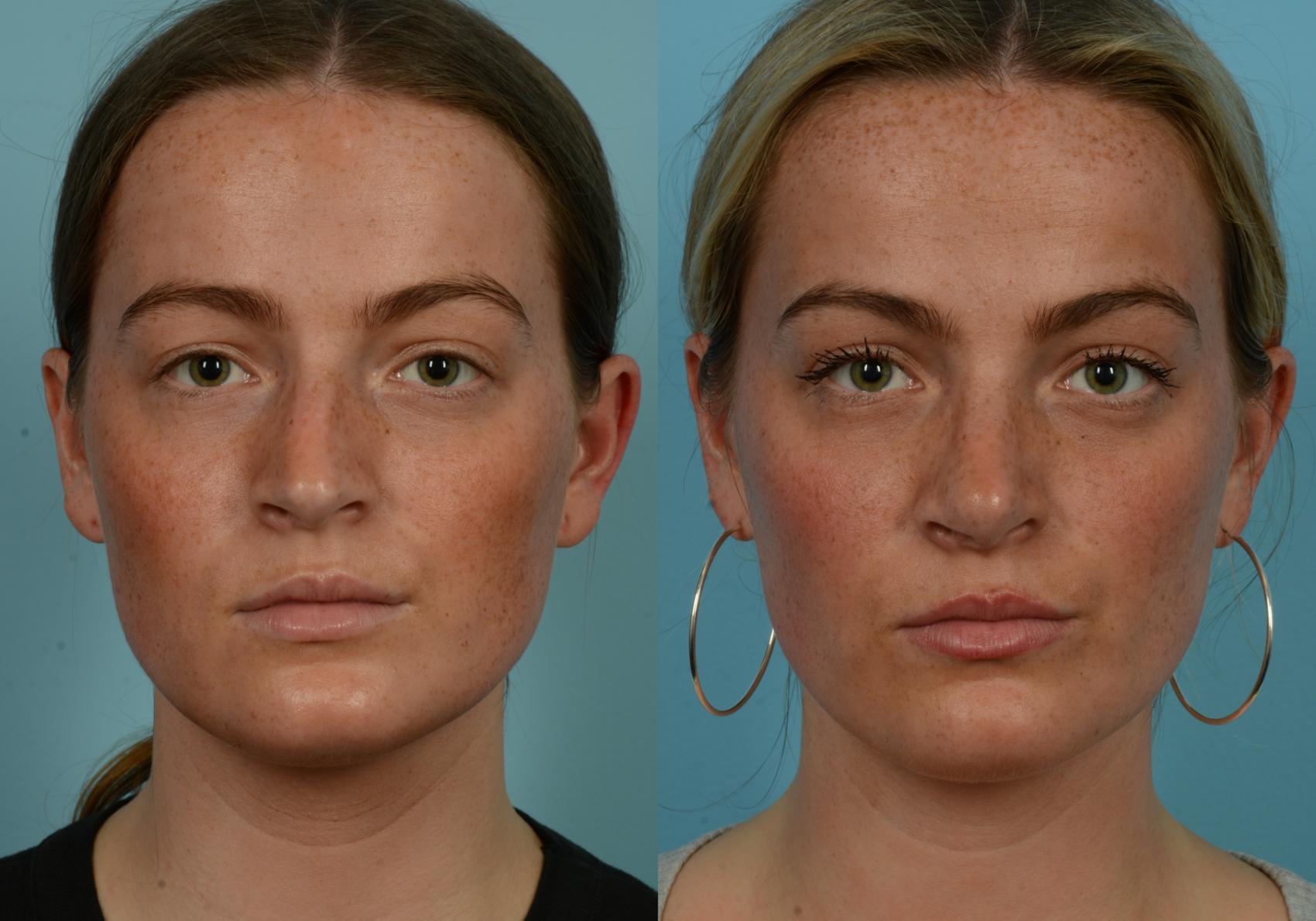 Before & After Rhinoplasty by Dr. Mustoe Case 1108 Front View in Chicago, IL