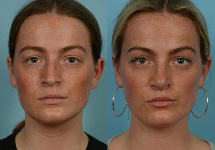 Before & After Rhinoplasty by Dr. Mustoe Case 1108 Front View in Chicago, IL