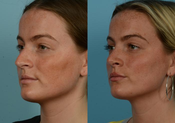 Before & After Rhinoplasty by Dr. Mustoe Case 1108 Left Oblique View in Chicago, IL