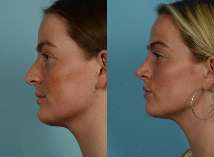 Before & After Rhinoplasty by Dr. Mustoe Case 1108 Left Side View in Chicago, IL