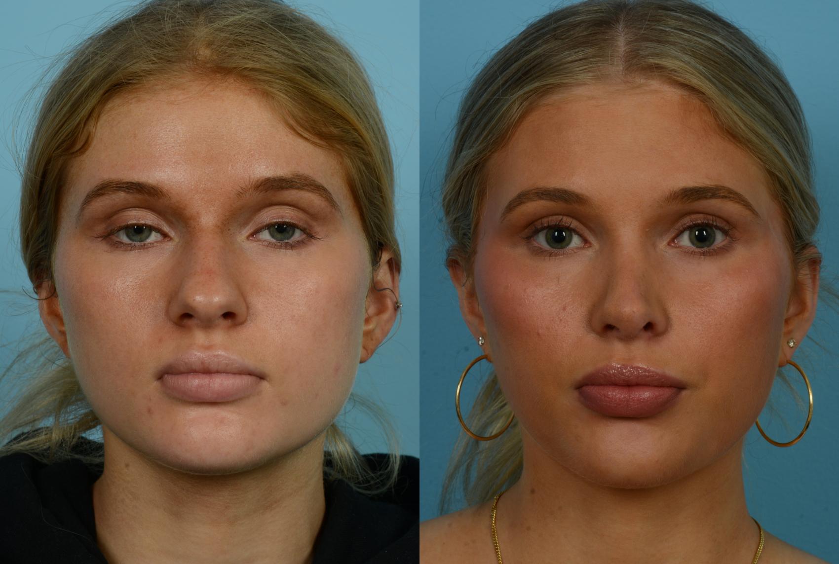 Before & After Rhinoplasty by Dr. Mustoe Case 1109 Front View in Chicago, IL