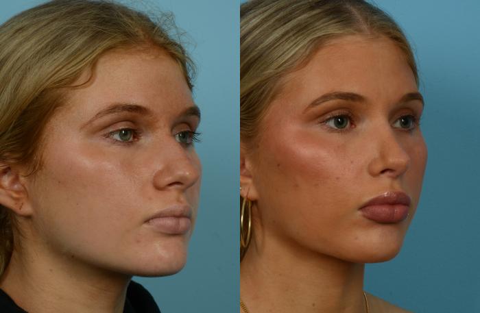 Before & After Rhinoplasty by Dr. Mustoe Case 1109 Right Oblique View in Chicago, IL
