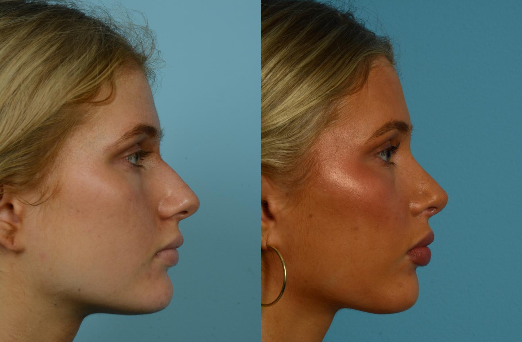 Before & After Rhinoplasty by Dr. Mustoe Case 1109 Right Side View in Chicago, IL