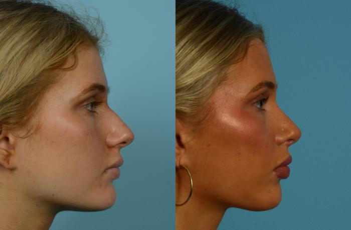 Before & After Rhinoplasty by Dr. Mustoe Case 1109 Right Side View in Chicago, IL