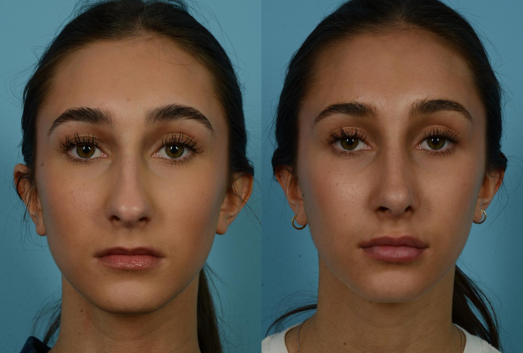 Before & After Rhinoplasty by Dr. Mustoe Case 1134 Front View in Chicago, IL