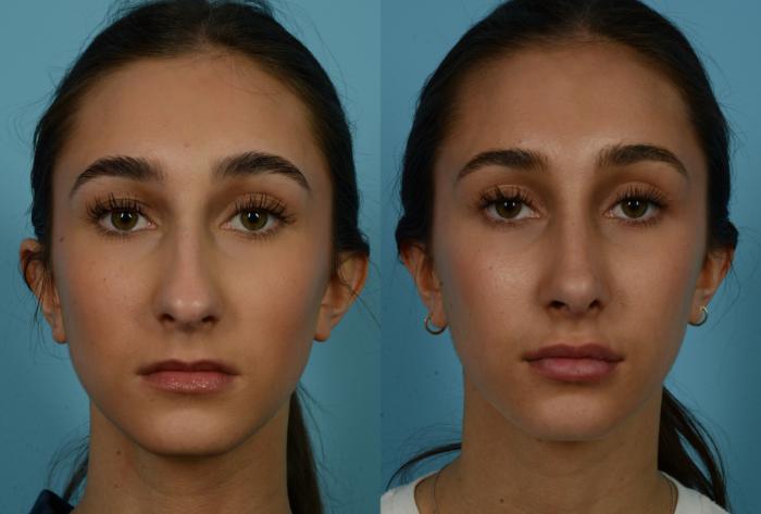 Before & After Rhinoplasty by Dr. Mustoe Case 1134 Front View in Chicago, IL