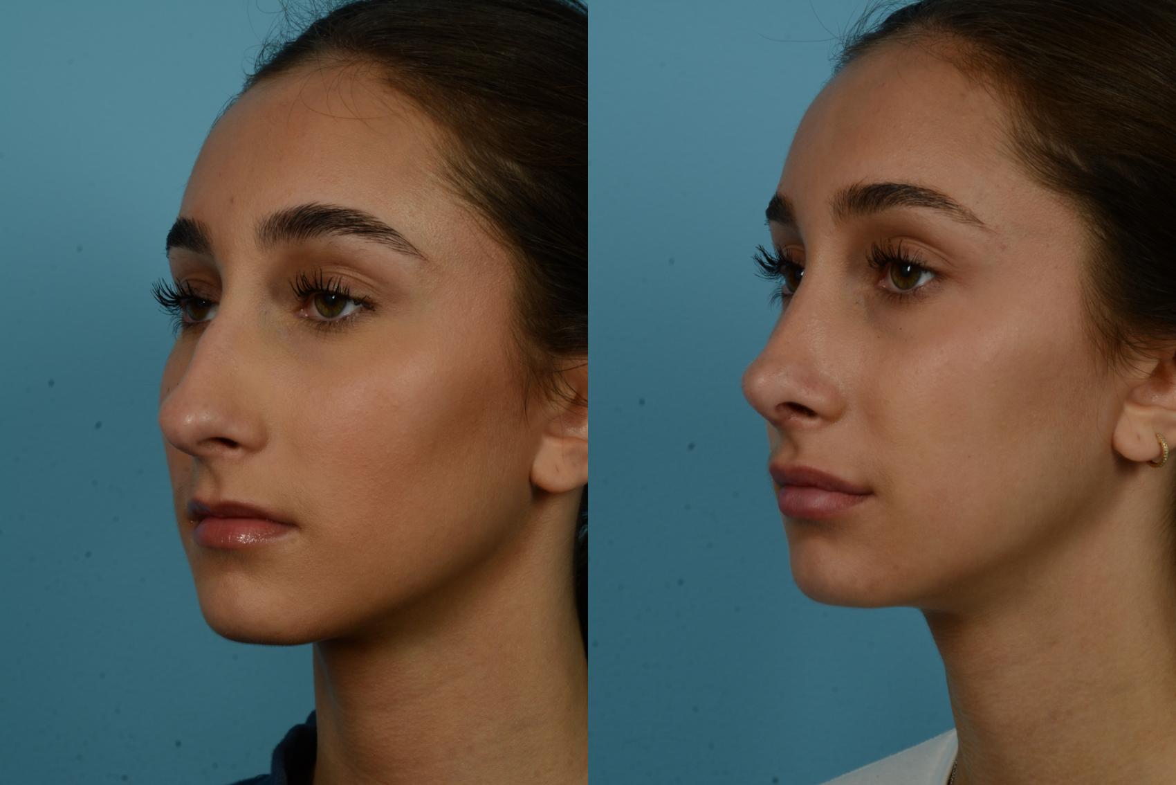 Before & After Rhinoplasty by Dr. Mustoe Case 1134 Left Oblique View in Chicago, IL