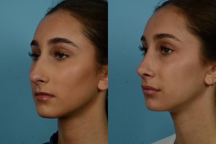 Before & After Rhinoplasty by Dr. Mustoe Case 1134 Left Oblique View in Chicago, IL