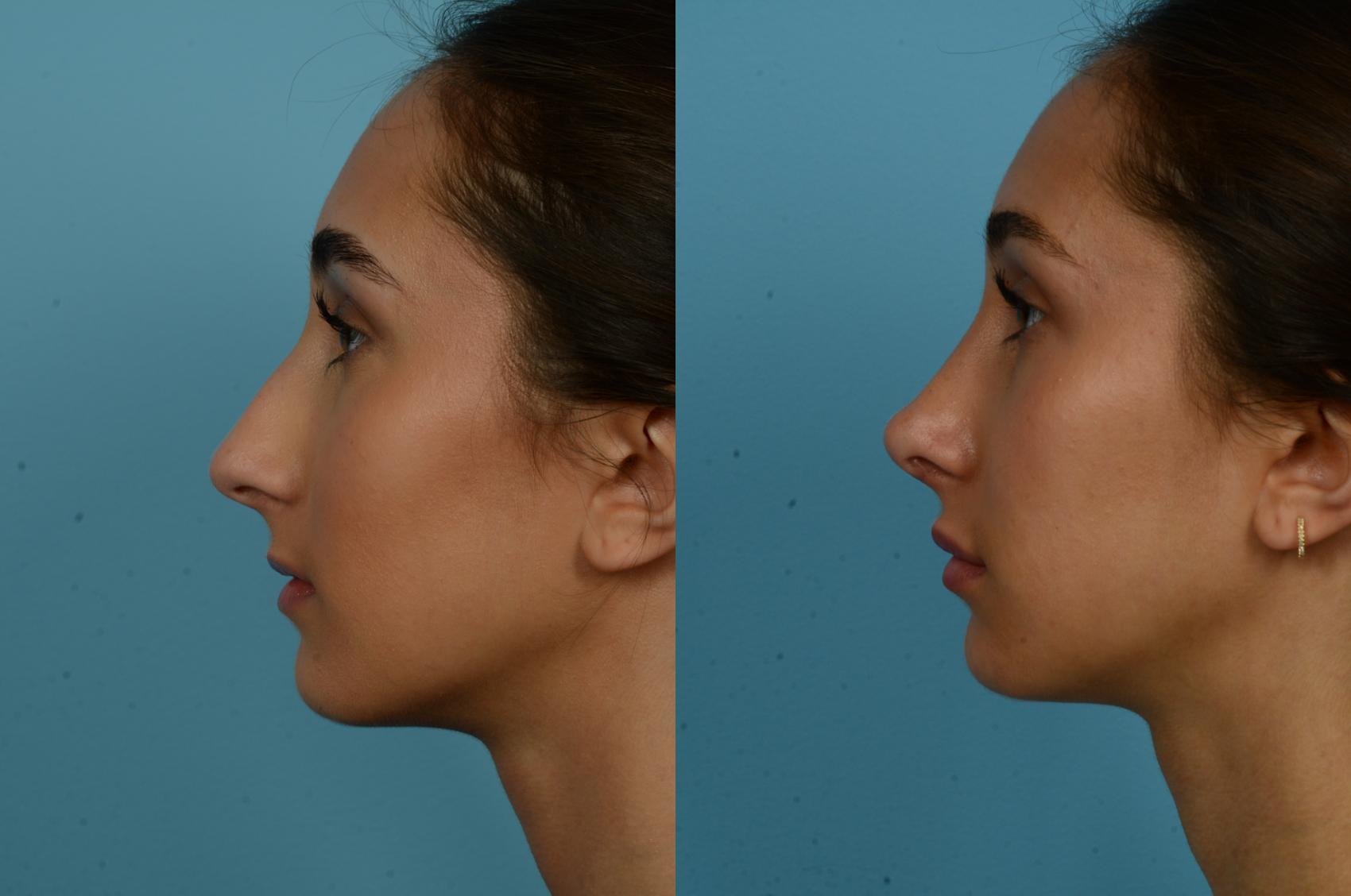 Before & After Rhinoplasty by Dr. Mustoe Case 1134 Left Side View in Chicago, IL