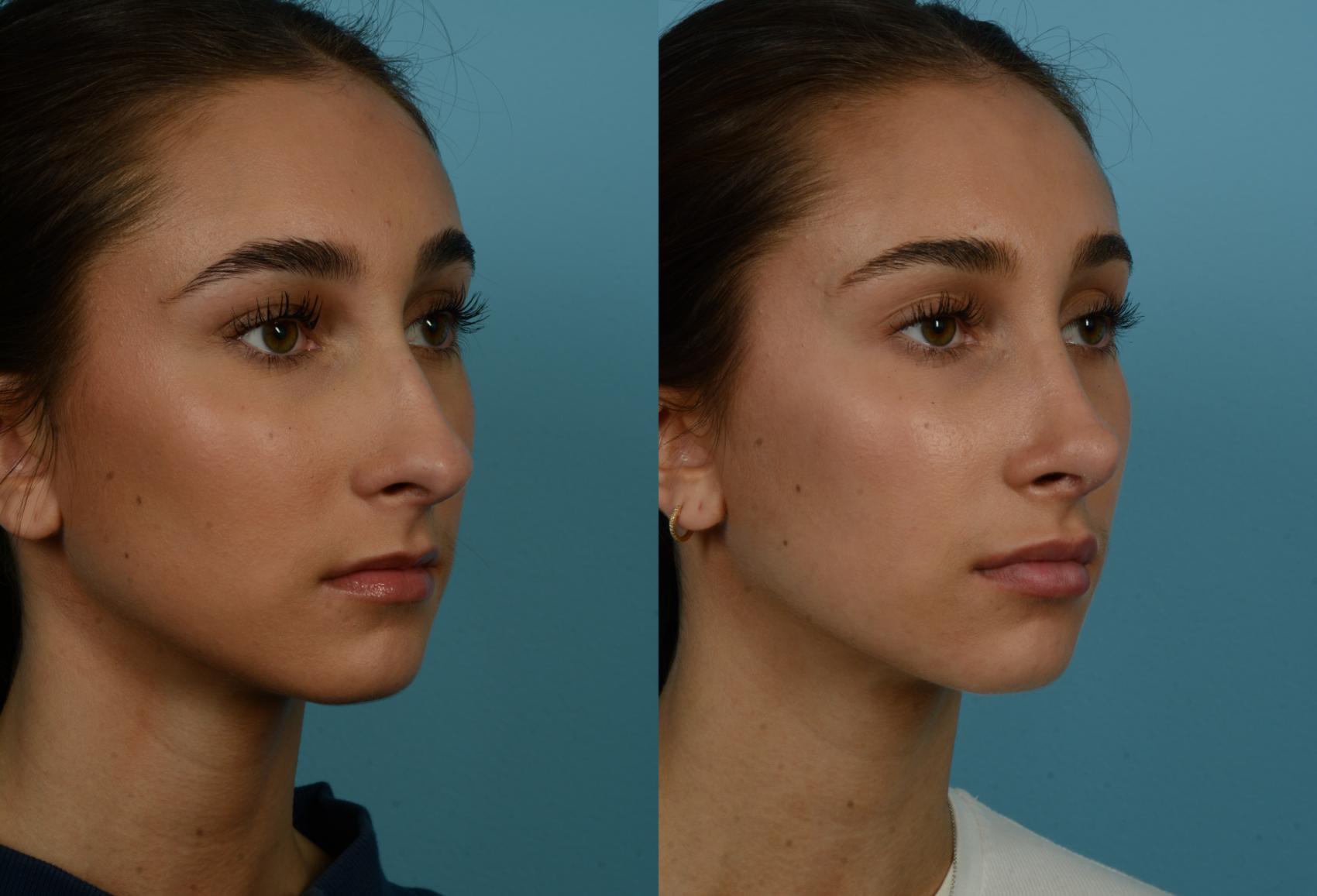 Before & After Rhinoplasty by Dr. Mustoe Case 1134 Right Oblique View in Chicago, IL