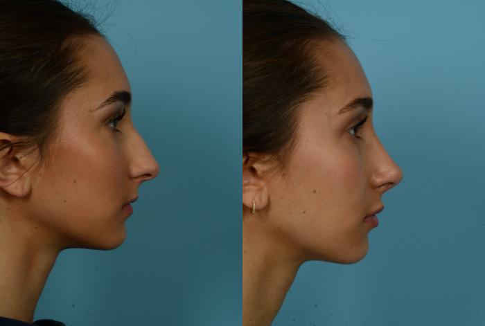 Before & After Rhinoplasty by Dr. Mustoe Case 1134 Right Side View in Chicago, IL