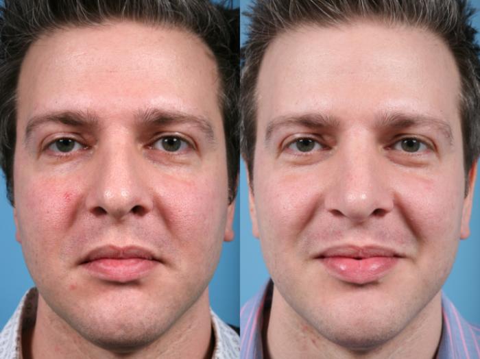 Before & After Rhinoplasty by Dr. Mustoe Case 12 Front View in Chicago, IL