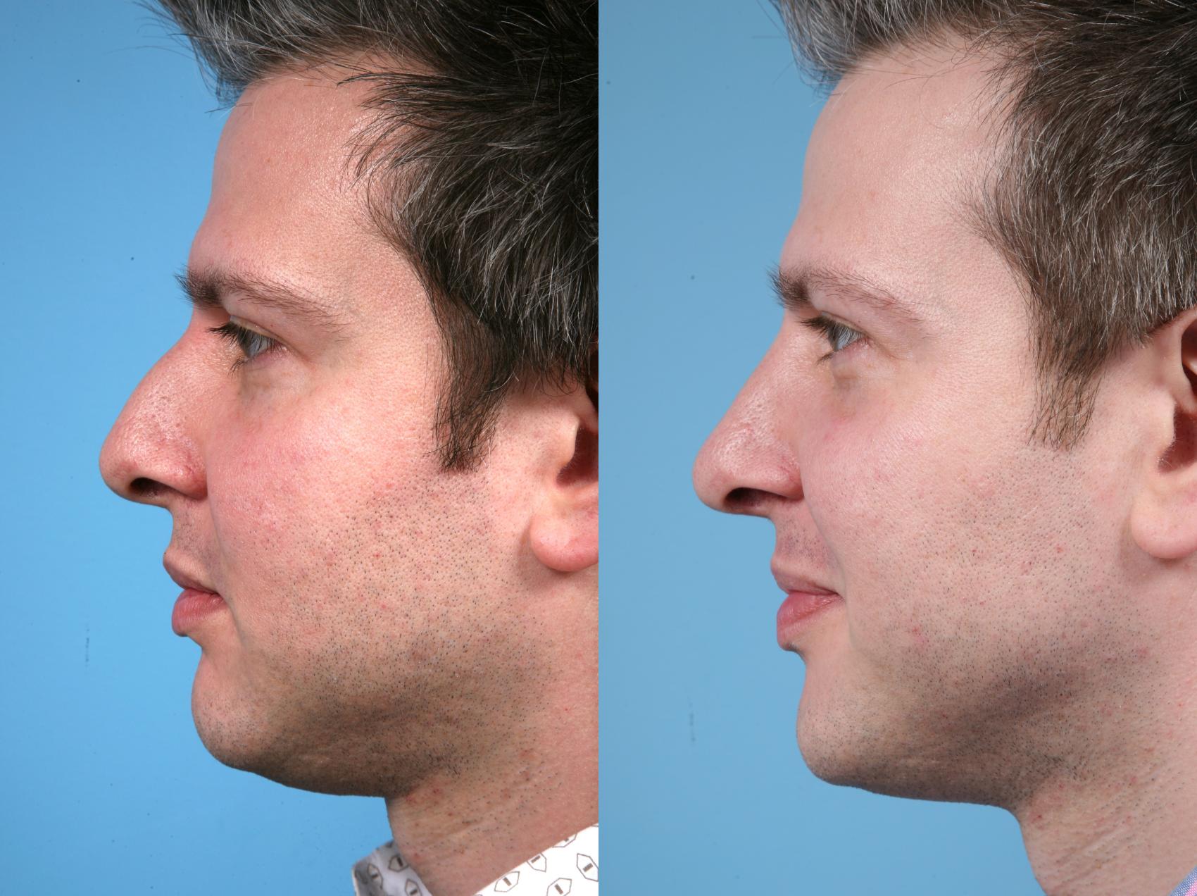 Before & After Rhinoplasty by Dr. Mustoe Case 12 Left Side View in Chicago, IL