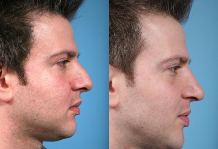 Before & After Rhinoplasty by Dr. Mustoe Case 12 Right Side View in Chicago, IL