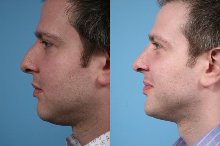 Before & After Rhinoplasty by Dr. Mustoe Case 12 View #1 View in Chicago, IL