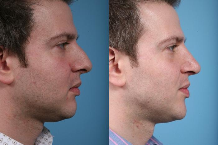 Before & After Rhinoplasty by Dr. Mustoe Case 12 View #2 View in Chicago, IL