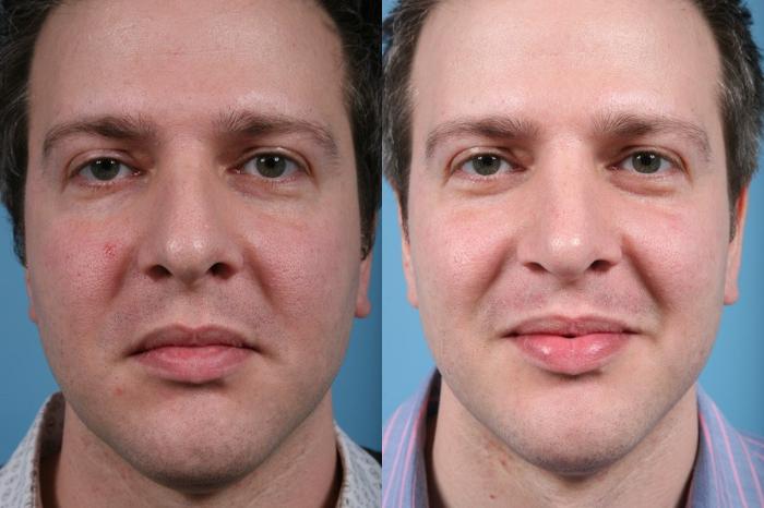 Before & After Rhinoplasty by Dr. Mustoe Case 12 View #3 View in Chicago, IL