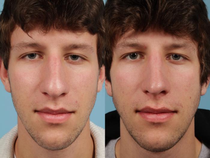 Before & After Rhinoplasty by Dr. Mustoe Case 139 Front View in Chicago, IL