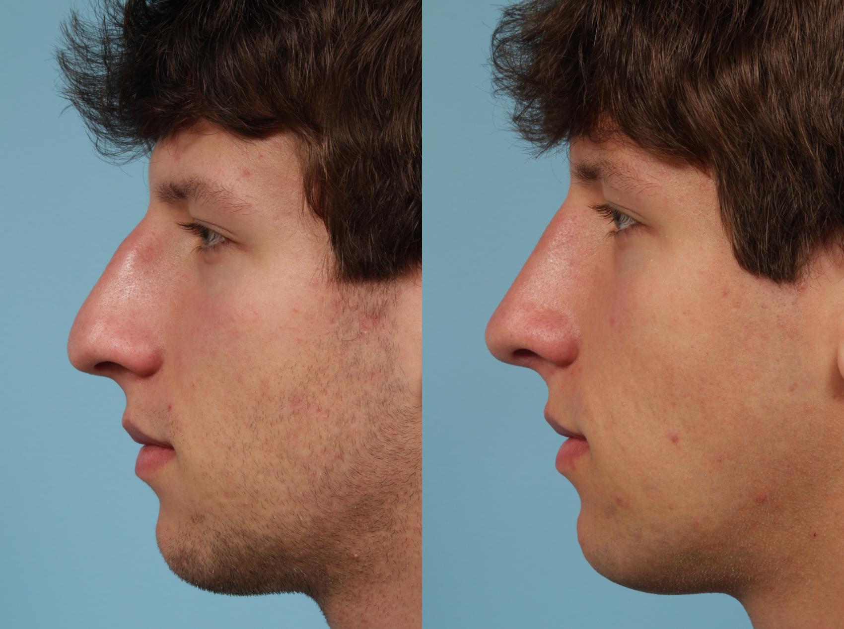 Before & After Rhinoplasty by Dr. Mustoe Case 139 Left Side View in Chicago, IL