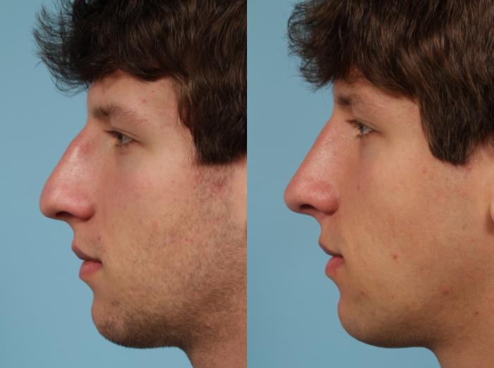 Before & After Rhinoplasty by Dr. Mustoe Case 139 Left Side View in Chicago, IL