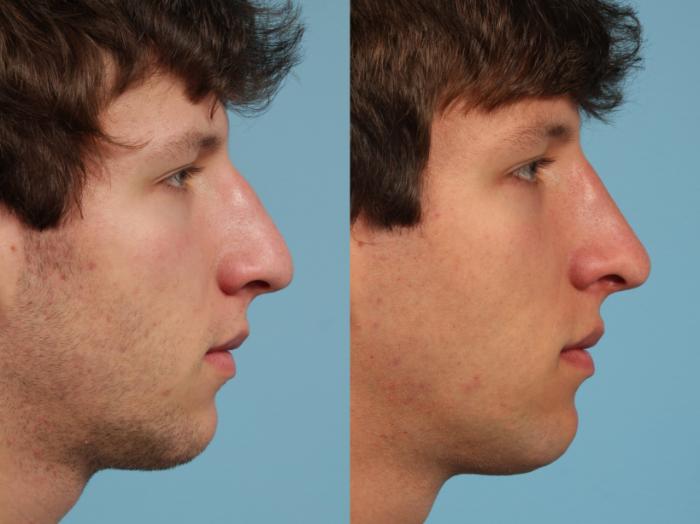 Before & After Rhinoplasty by Dr. Mustoe Case 139 Right Side View in Chicago, IL