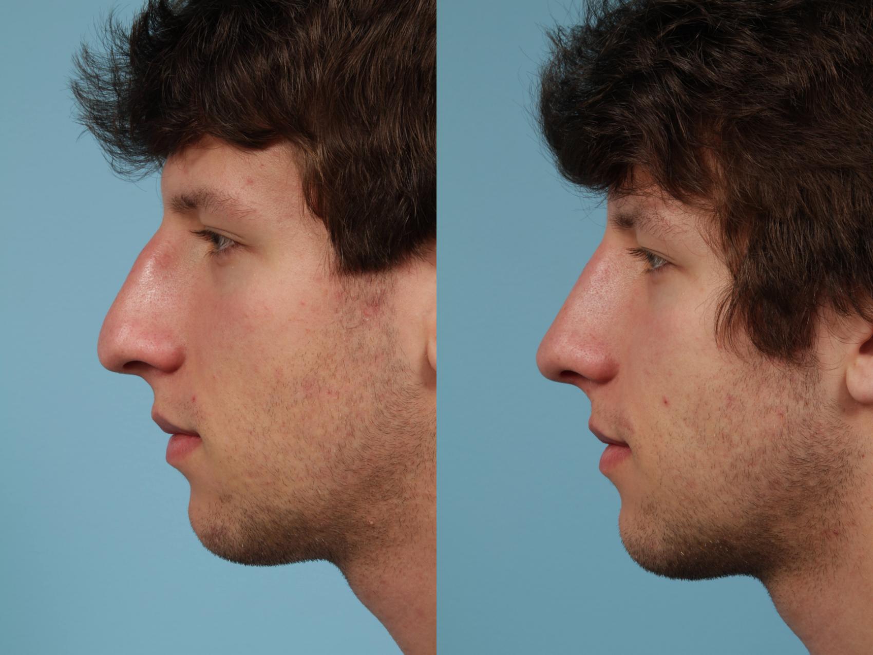 Before & After Rhinoplasty by Dr. Mustoe Case 139 View #1 View in Chicago, IL