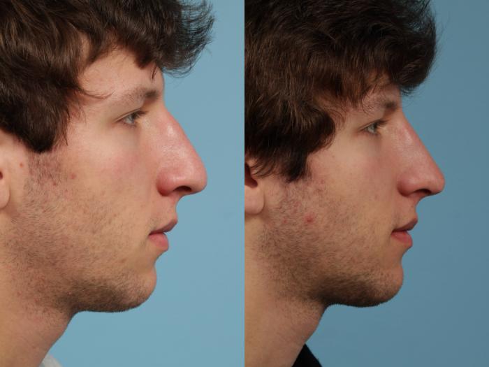 Before & After Rhinoplasty by Dr. Mustoe Case 139 View #2 View in Chicago, IL