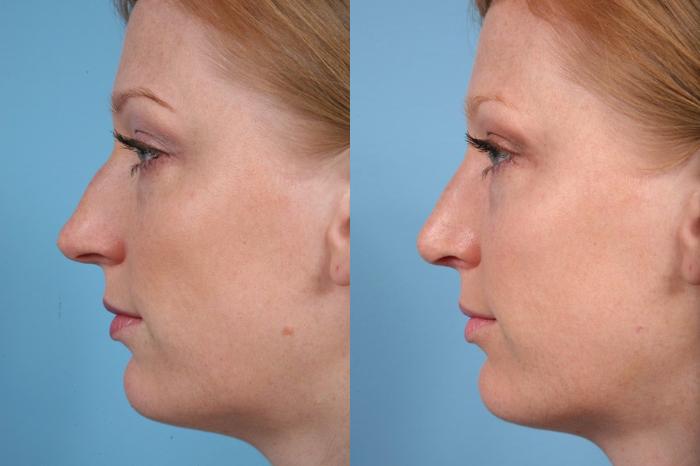 Before & After Rhinoplasty by Dr. Mustoe Case 18 View #1 View in Chicago, IL
