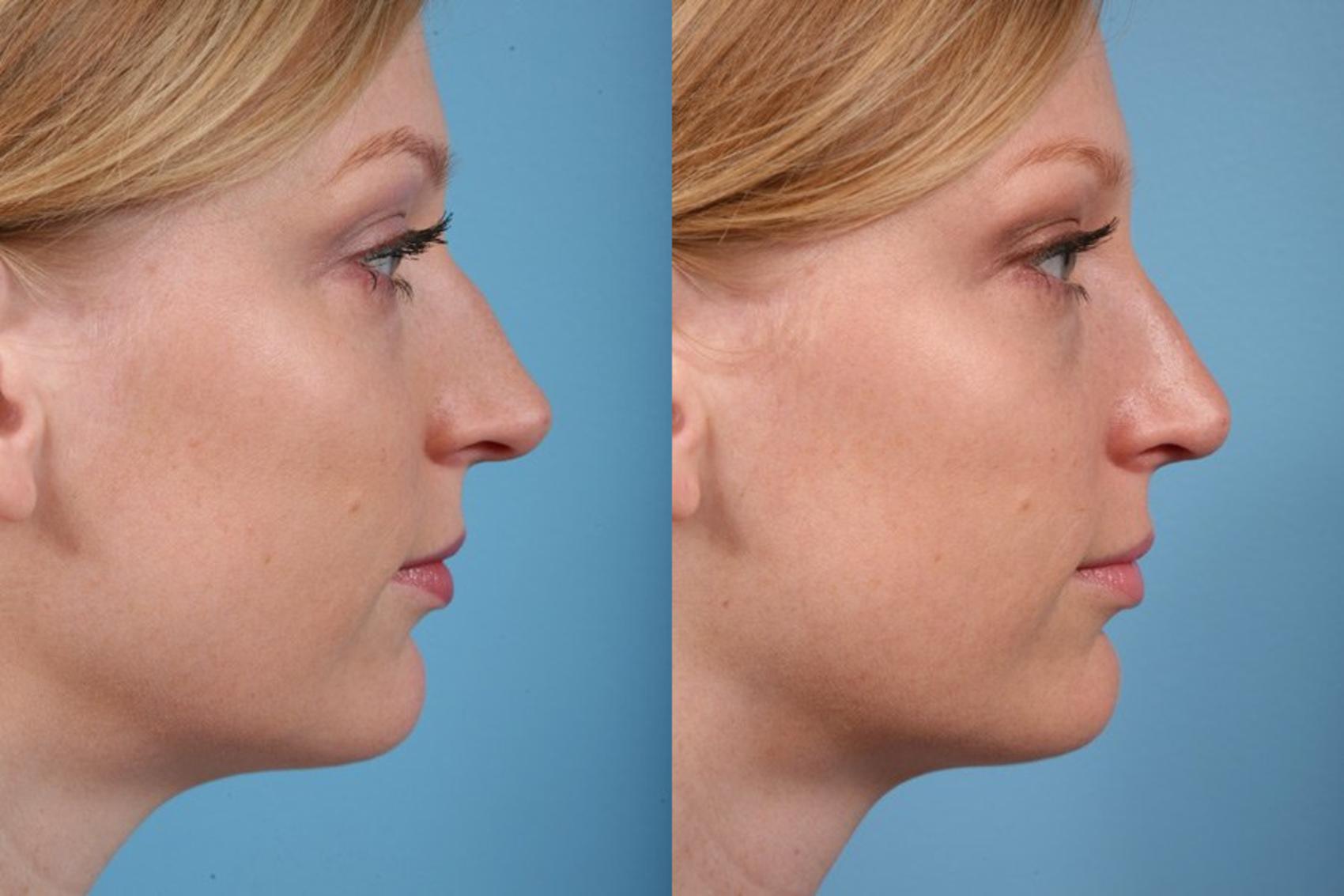 Rhinoplasty by Dr. Mustoe Before and After Pictures Case 18 | Chicago 