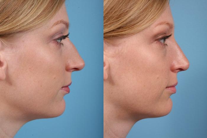 Before & After Rhinoplasty by Dr. Mustoe Case 18 View #2 View in Chicago, IL