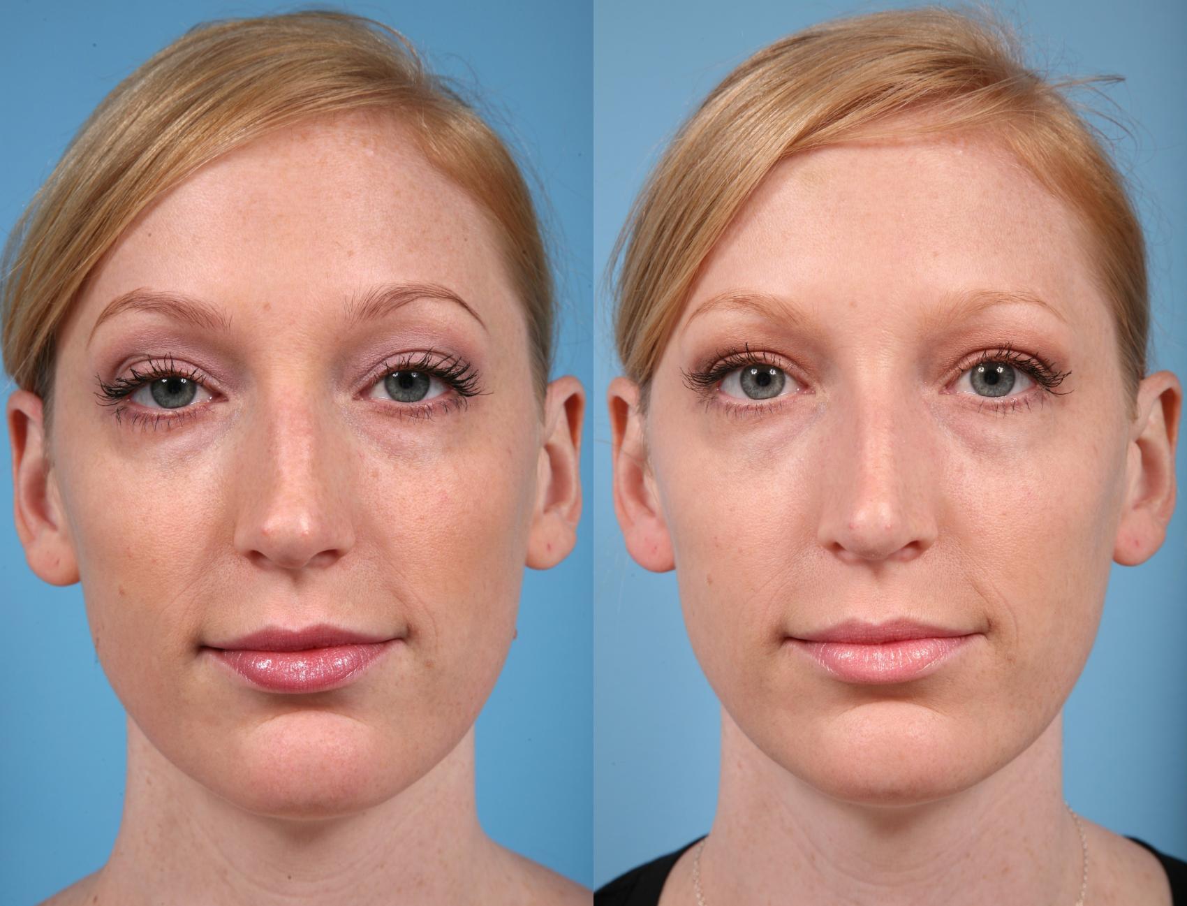 Rhinoplasty By Dr Mustoe Before And After Pictures Case 18 Chicago Il Tlkm Plastic Surgery 