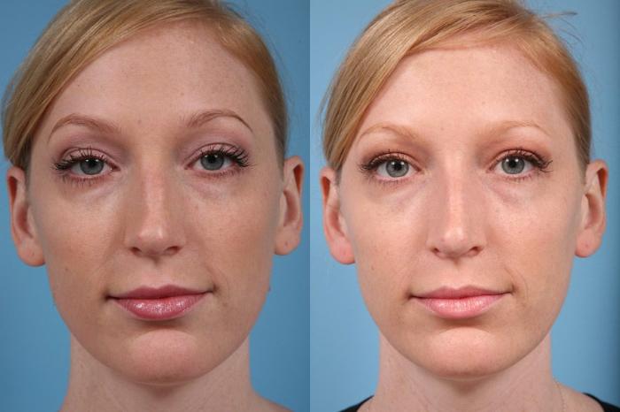 Before & After Rhinoplasty by Dr. Mustoe Case 18 View #3 View in Chicago, IL