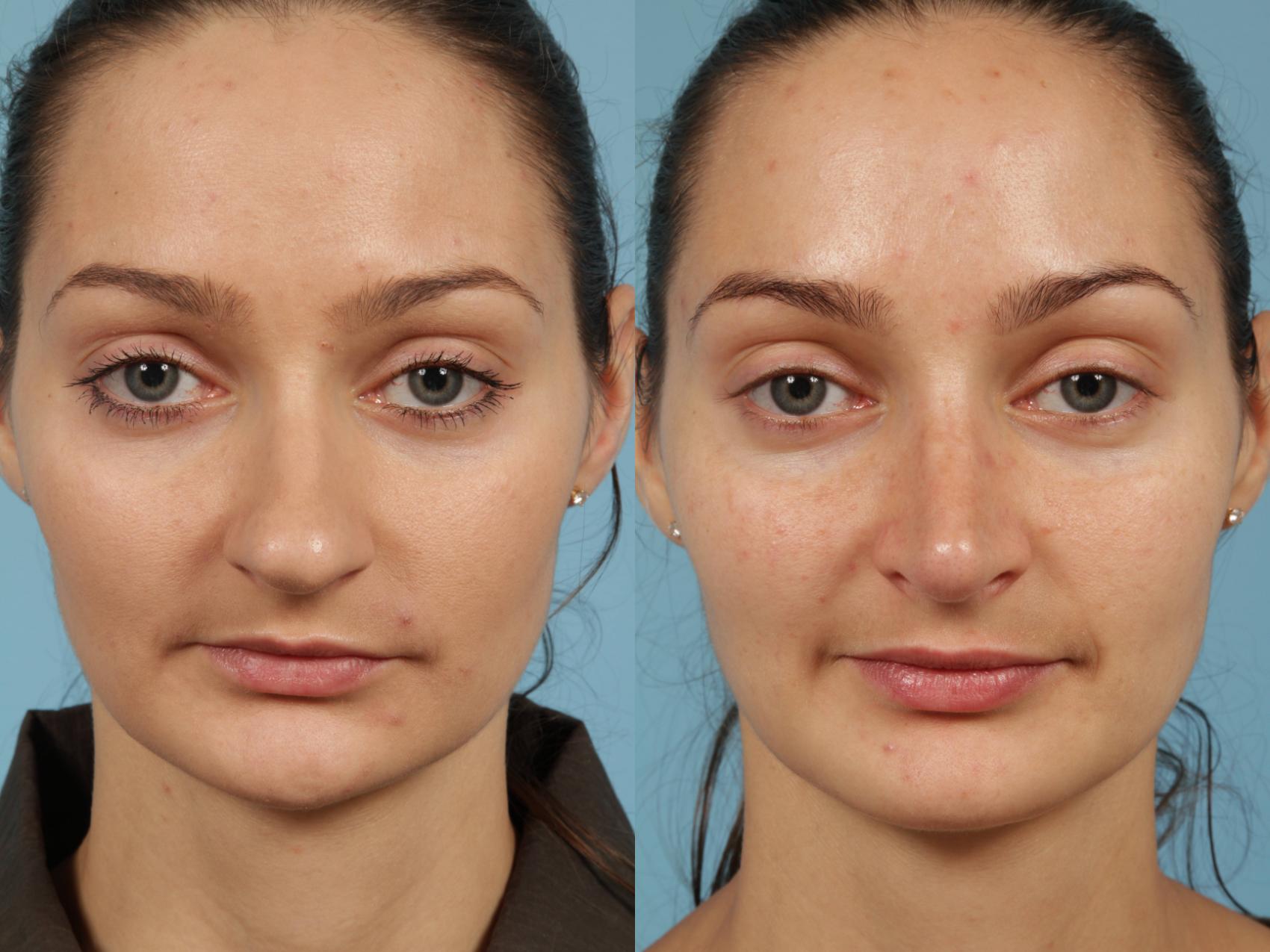 Before & After Rhinoplasty by Dr. Mustoe Case 187 View #2 View in Chicago, IL