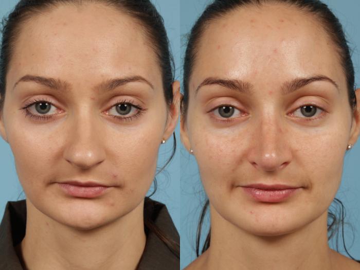 Before & After Rhinoplasty by Dr. Mustoe Case 187 View #2 View in Chicago, IL