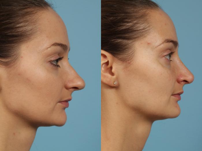Before & After Rhinoplasty by Dr. Mustoe Case 187 View #3 View in Chicago, IL