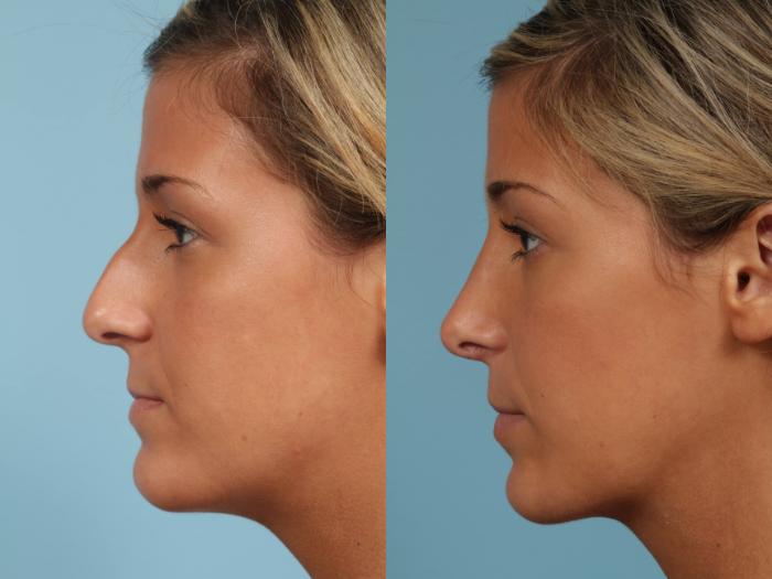 Before & After Rhinoplasty by Dr. Mustoe Case 189 View #3 View in Chicago, IL