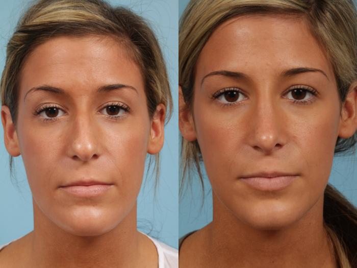 Before & After Rhinoplasty by Dr. Mustoe Case 189 View #5 View in Chicago, IL