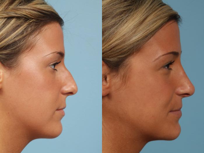 Before & After Rhinoplasty by Dr. Mustoe Case 189 View #6 View in Chicago, IL