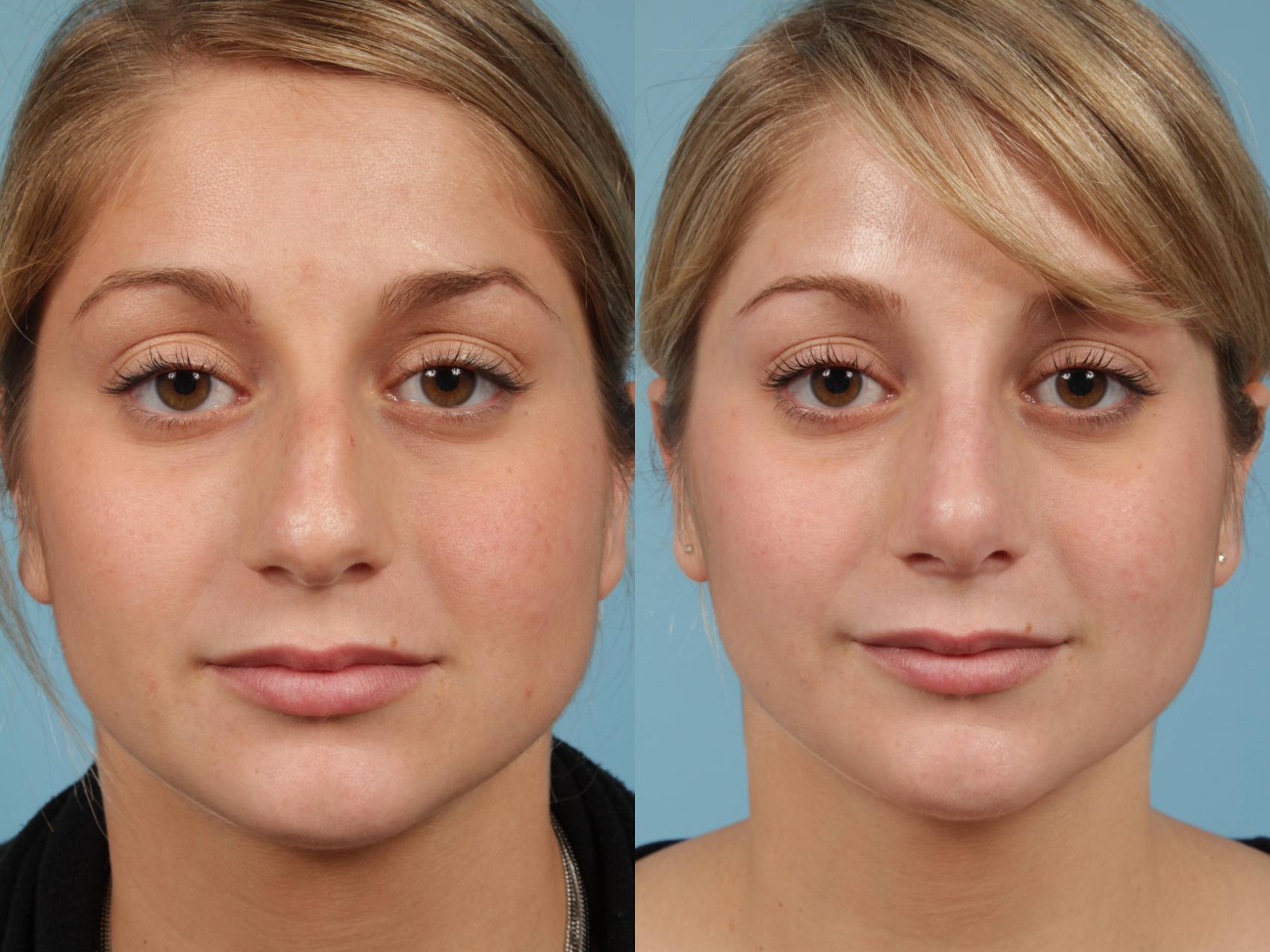 Rhinoplasty By Dr Mustoe Before And After Pictures Case 194 Chicago Il Tlkm Plastic Surgery 