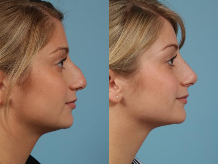 Before & After Rhinoplasty by Dr. Mustoe Case 194 View #3 View in Chicago, IL