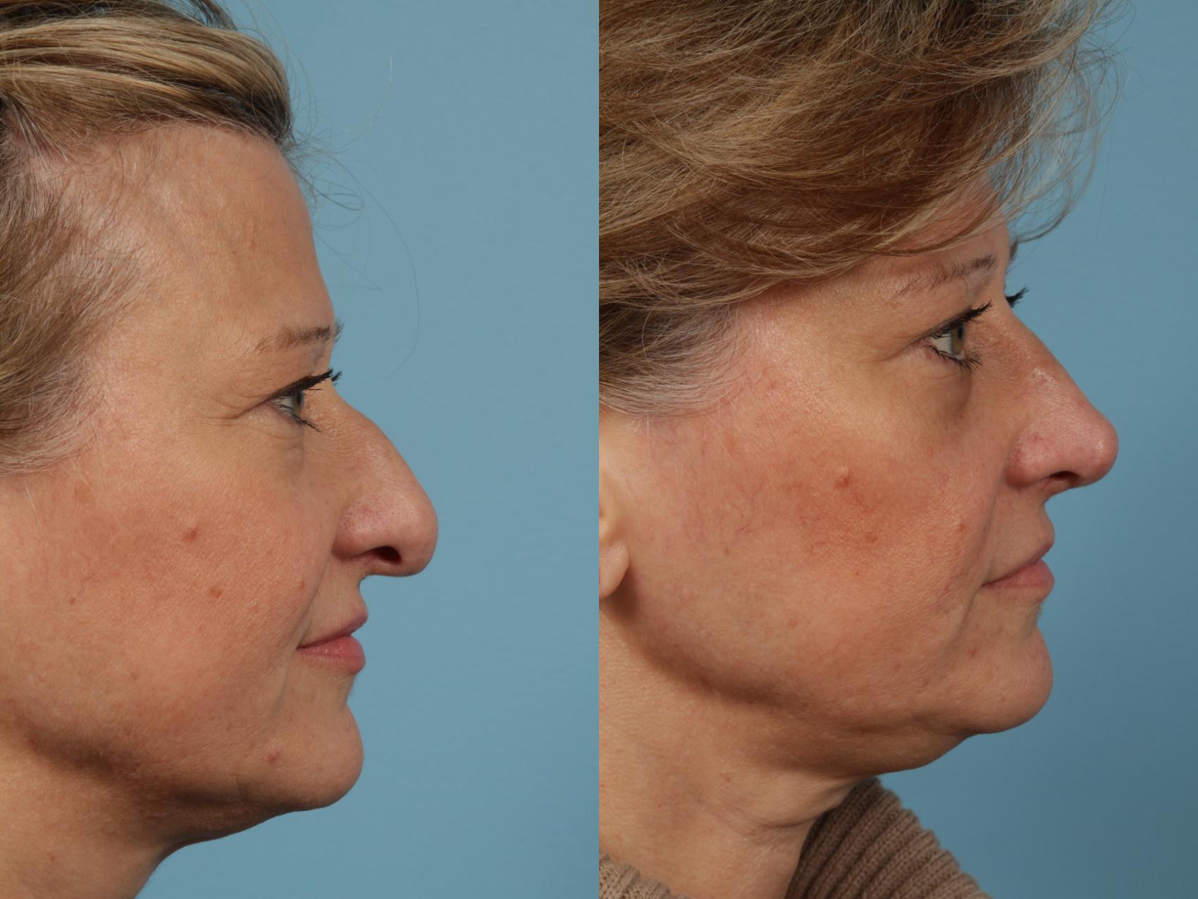 Before & After Rhinoplasty by Dr. Mustoe Case 214 View #2 View in Chicago, IL