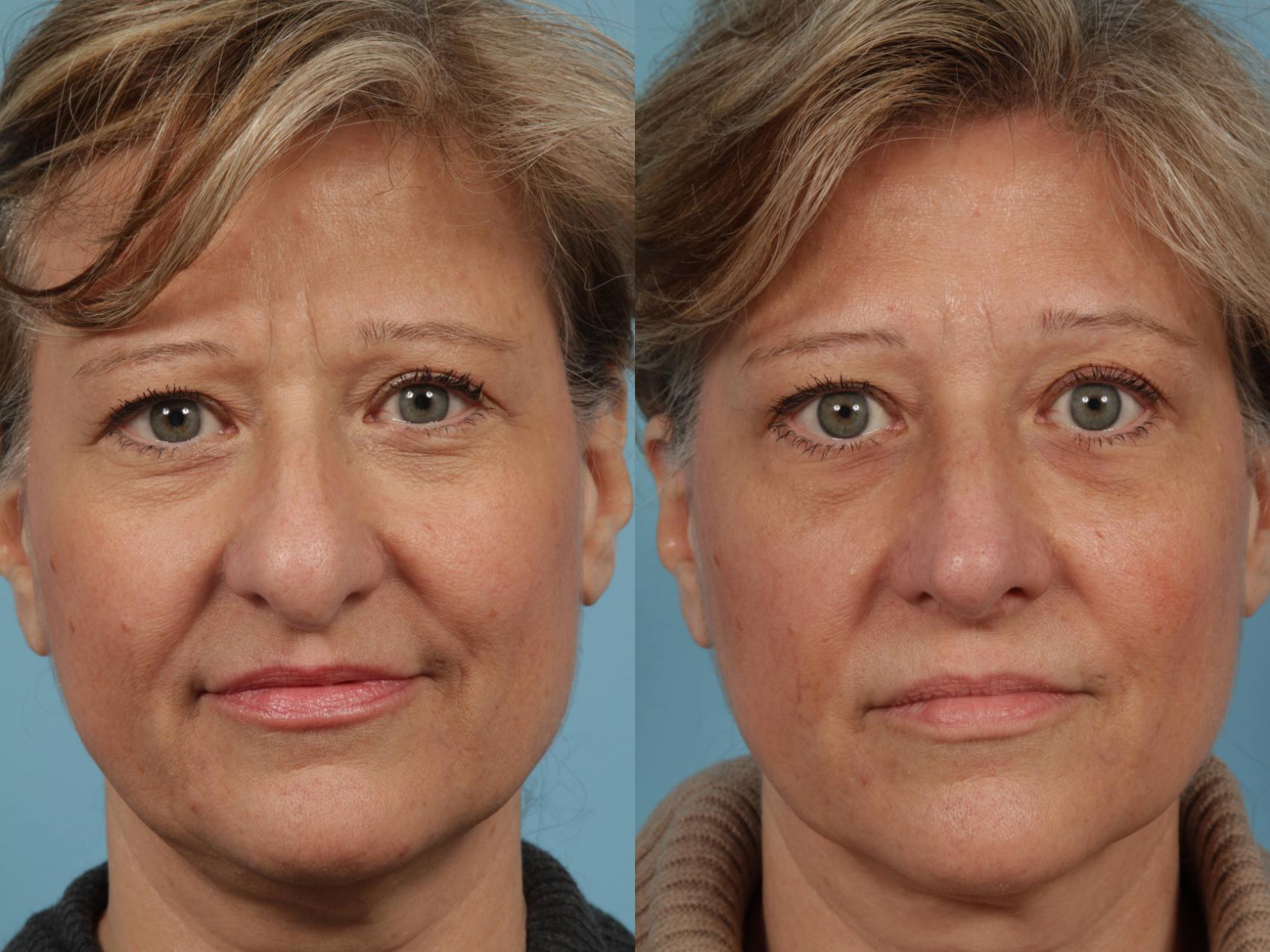 Before & After Rhinoplasty by Dr. Mustoe Case 214 View #3 View in Chicago, IL
