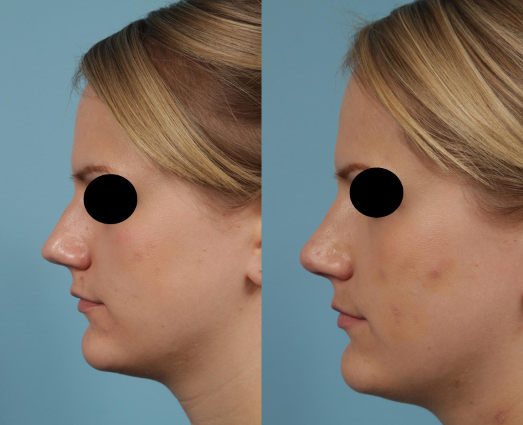 Before & After Rhinoplasty by Dr. Mustoe Case 232 View #2 View in Chicago, IL
