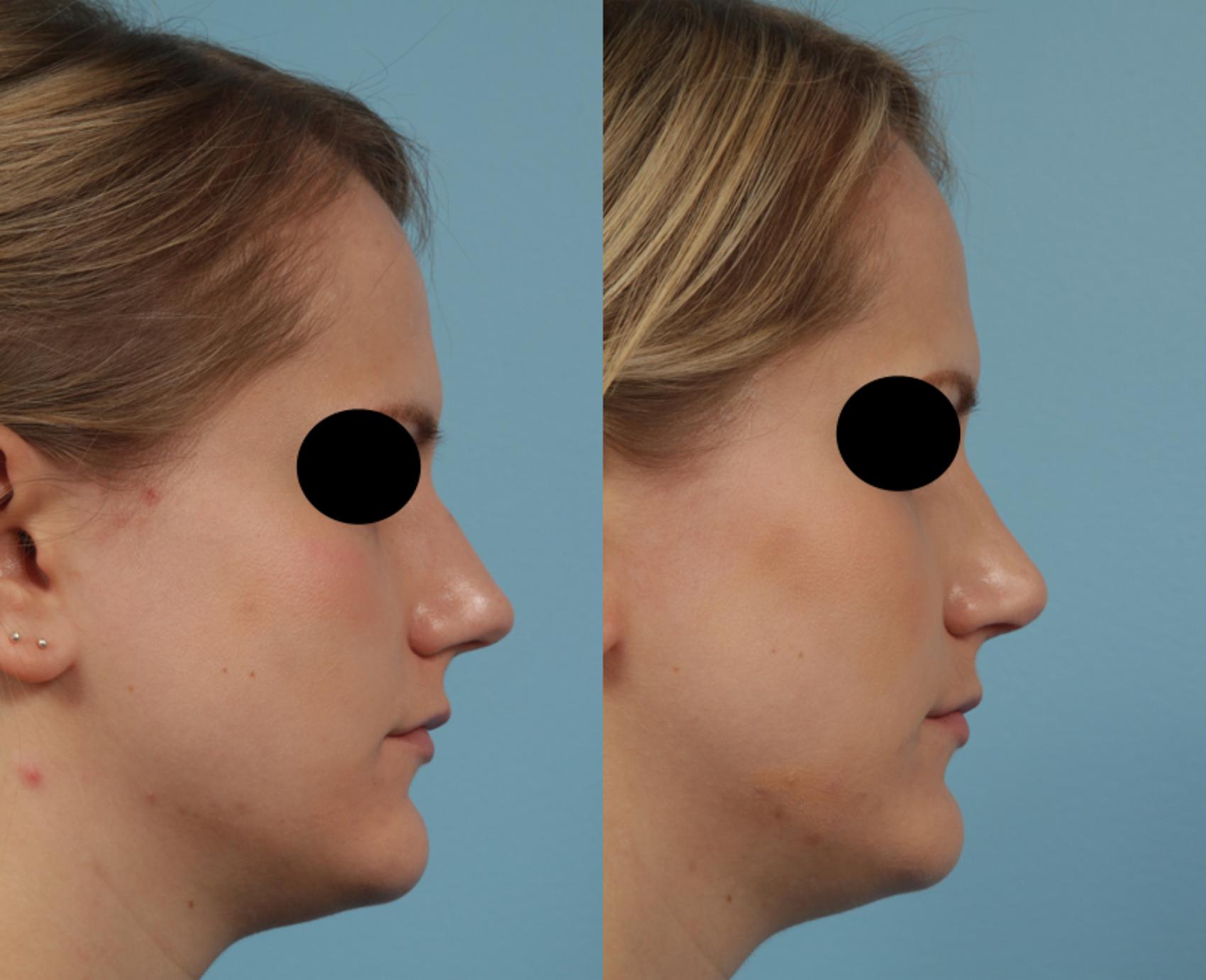Before & After Rhinoplasty by Dr. Mustoe Case 232 View #4 View in Chicago, IL