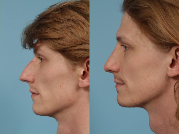 Before & After Rhinoplasty by Dr. Mustoe Case 239 View #1 View in Chicago, IL