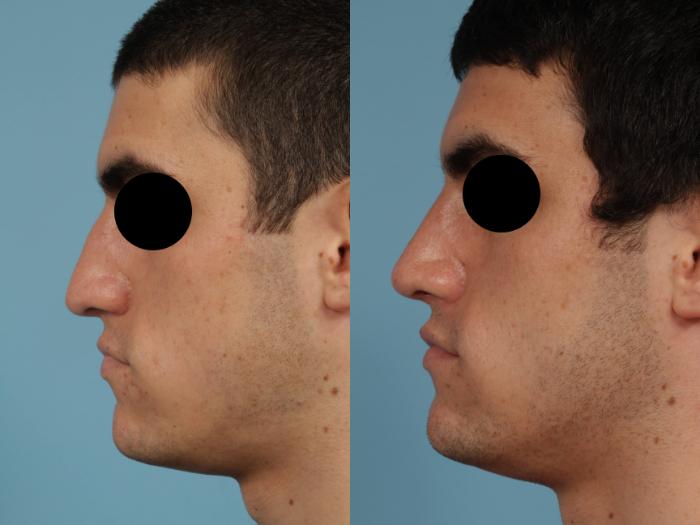 Before & After Rhinoplasty by Dr. Mustoe Case 243 View #5 View in Chicago, IL