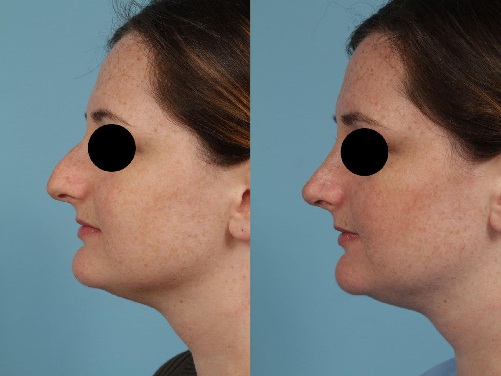 Before & After Rhinoplasty by Dr. Mustoe Case 246 View #7 View in Chicago, IL